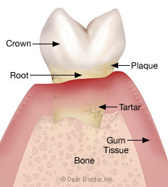 Stage 3 - Moderate periodontitis.