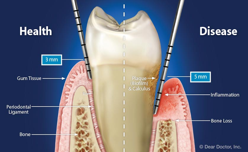 Understanding Periodontal Pockets