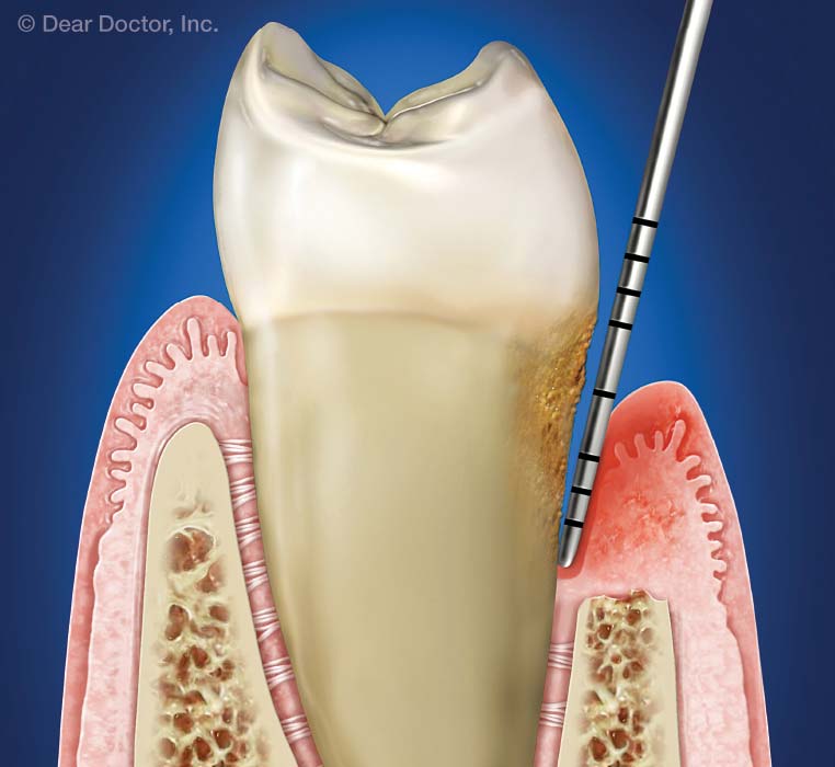 Periodontal pockets.