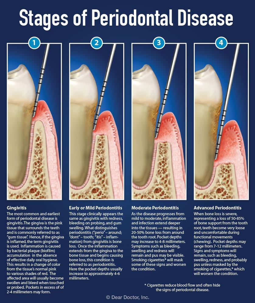 Dental Pocket Depth Chart