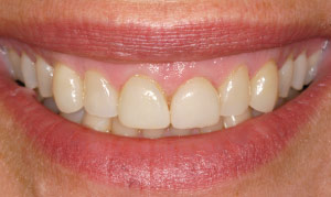 Before periodontal plastic surgery.