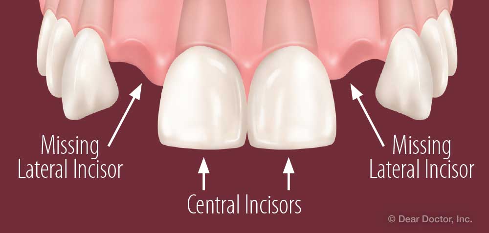 Missing lateral incisors.