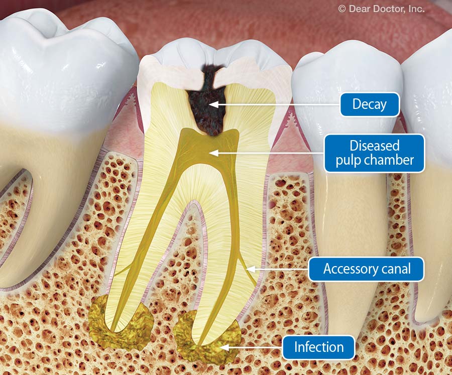 Root canal treatment.