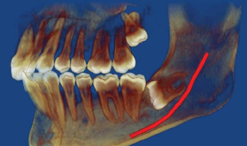 Slightly tilted wisdom tooth.