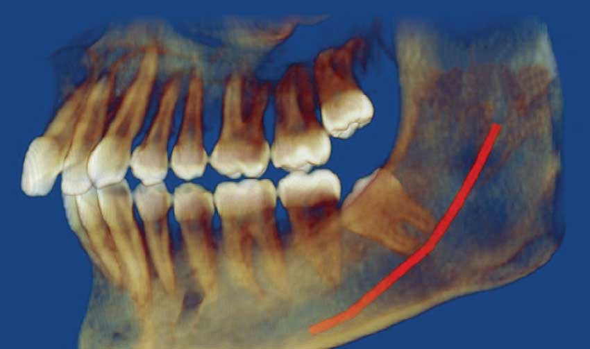 Tilted wisdom tooth.