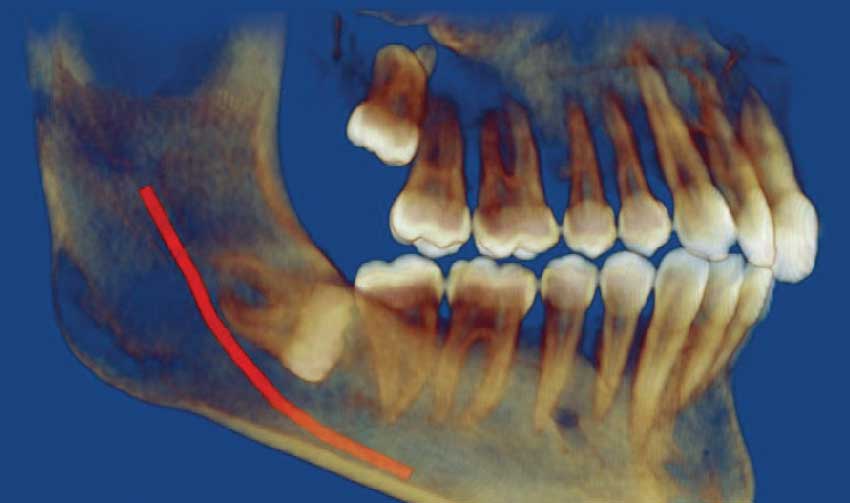 Horizontally impacted wisdom tooth.