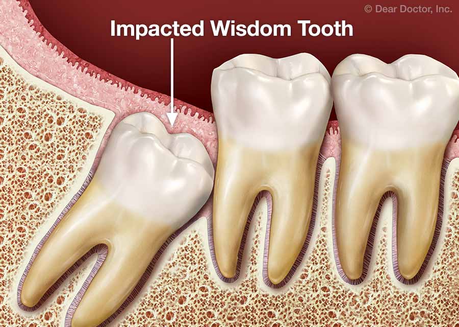 Wisdom teeth treatment options.