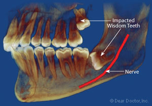 Impacted wisdom tooth.