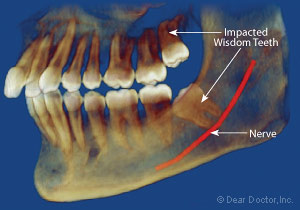 Impacted wisdom tooth.