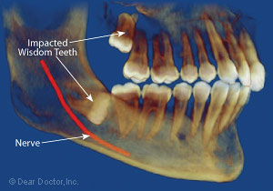 Impacted wisdom tooth.