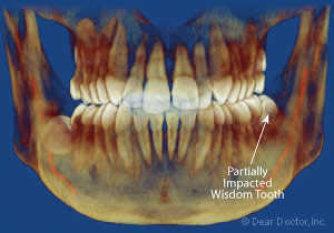 Partially impacted wisdom tooth.