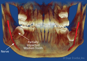 Partially impacted wisdom tooth.