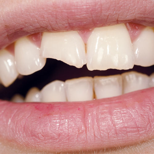 It’s Easy (and Smart) to Fix a Chipped Tooth