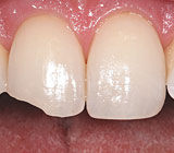 Is Chipping a Tooth Really that Big of a Deal?