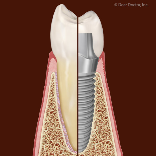 Although Rare, Dental Implant Failures Are Tied to Certain Health Factors