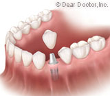 Dental Implants – The Best Tooth Replacements in History