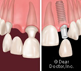 Dental Implants or Bridgework – Making The Best Choice