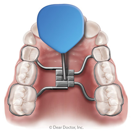 What Is a Palatal Expander?