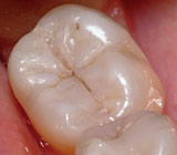 The Natural Beauty of Tooth-Colored Fillings