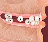 If A Back Tooth Is Lost, Will You Miss It?