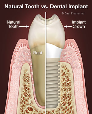 side by side illustration of natural tooth and root next to implant and crown, dental implants Royal Palm Beach, FL