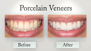 Porcelain veneer before and after.