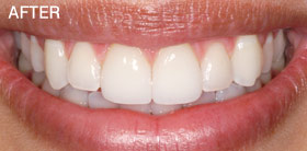 After Porcelain Veneers.