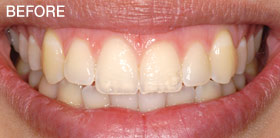 Before Porcelain Veneers.