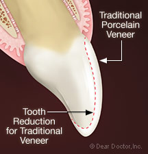 Porcelain veneers.