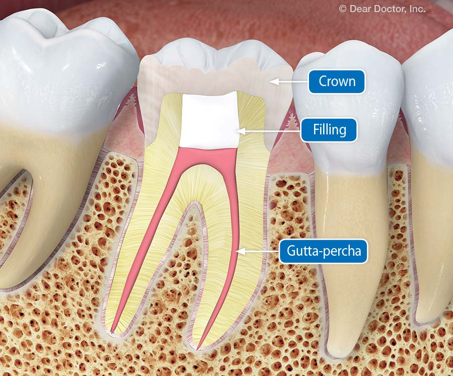 How To Tell If You Need A Root Canal After A Crown - What Is A Root ...