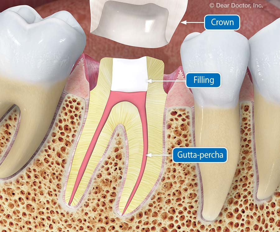 dente preparado.