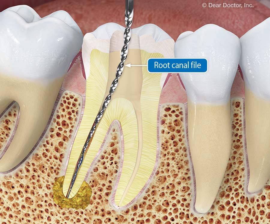 Root canal file.