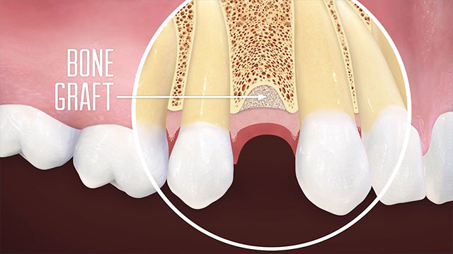 Bone Grafting