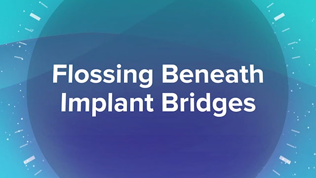 Flossing Beneath Implant Bridges