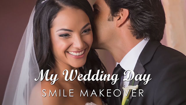 How Veneers Transformed My Wedding Day