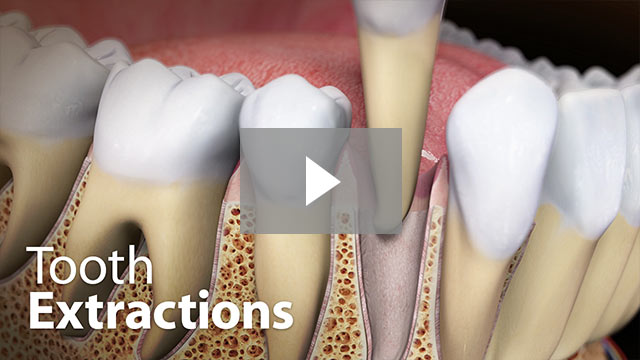 Tooth Extraction video
