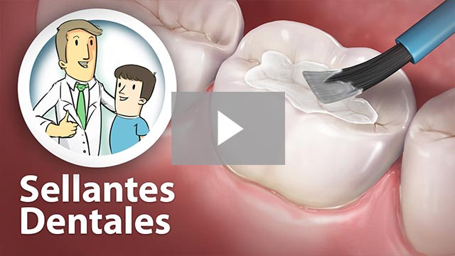 Sellantes Dentales (Dental Sealants)