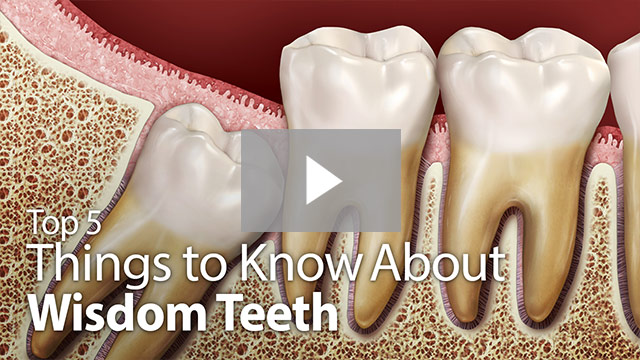 things to know about wisdom teeth