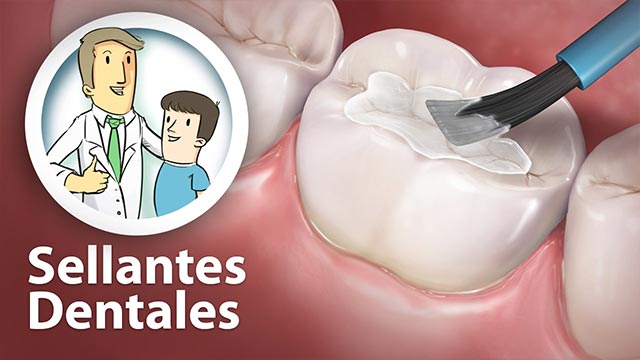 Sellantes Dentales