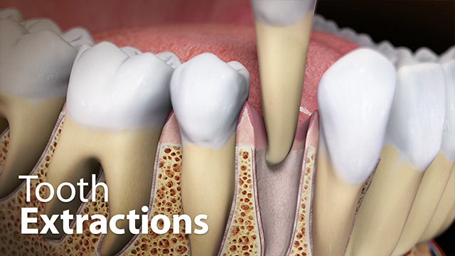 Tooth Extractions Video