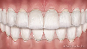 Clear aligners