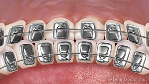 Lingual braces.