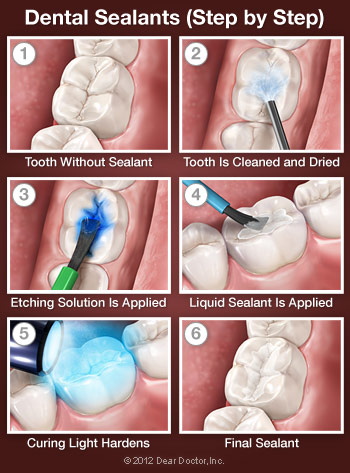 Dental Sealants - Step by Step.
