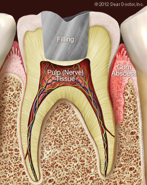 Gum abscess.