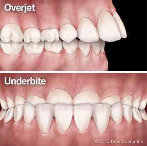 Overjet and Underbite.