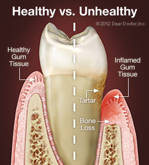 illustration of tooth, half healthy tooth half with Periodontitis Albuquerque, NM gum disease