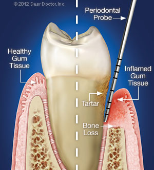 Image showing the difference between a healthy gum and one with periodontal disease.