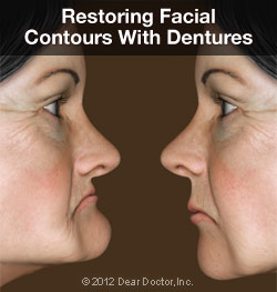 Normal facial contours restored with dentures.