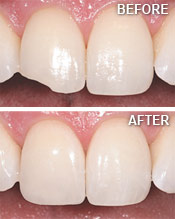 Cosmetic Resin Bonding, Advanced Dentistry