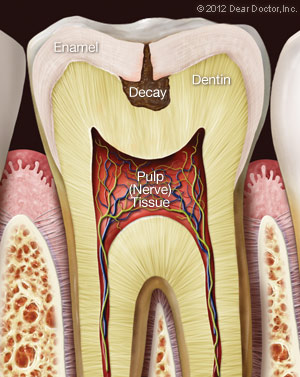 Slidell toothache caused by Tooth Decay